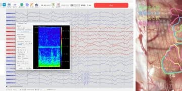 不做「马斯克」 中国科学家自研医疗级全植入式脑机接口